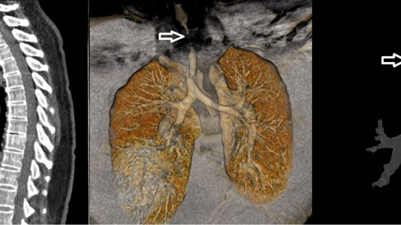 Trabzon'da Kovid-19 tedavisinin ardından soluk borusu darlığı yaşayan kadın ameliyatla sağlığına kavuştu
