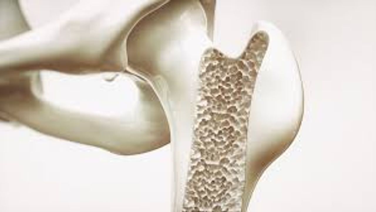 Osteoporoz tedavisi: Kemik yoğunluğunu artırmanın 7 doğal yolu