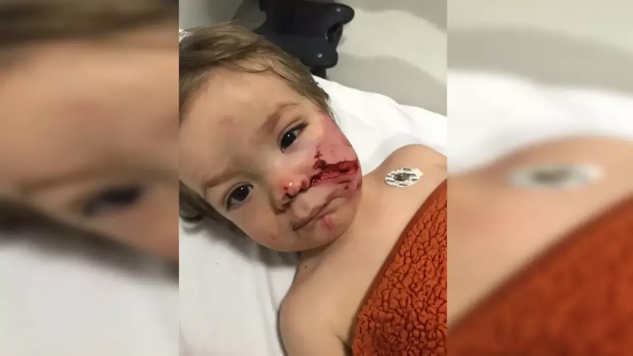 Etimesgut’ta Pitbull Saldırısı: İki Çocuk Yaralı