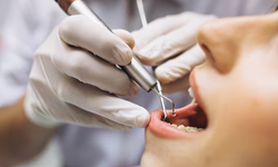 Dent266 ile Endodonti Uzmanı Tavsiyesi Güvenli Tedavi