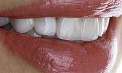 Sağlıklı ve Estetik Gülüşler İçin Diş Kaplama Süreci