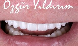 All On 6 Antalya: A Permanent Solution for a Confident Smile