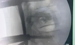 Trabzon’da Omurgasına Vida Takıldı, Sağlığına Kavuştu