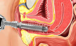 Genital Mezoterapi Nedir, Kimlere Uygulanır?
