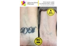 Antalya Dövme Silme Merkezi Lara Şubesinde Yeni Bir Başlangıç Yapın