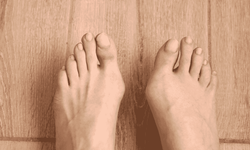 Halluks Valgus Gece Ateli: Gerçekten İşe Yarıyor mu, Yoksa Vakit Kaybı mı?