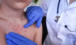 Kış Aylarında Uyuz Alarmı: Vakalar Hızla Artıyor