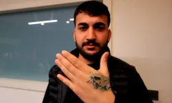 Dövme Sildirme İşlemi Kabusa Döndü, Elinde Yanık Oluştu