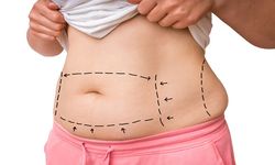 Diyetle Gitmeyen Yağlara Liposuction ile Veda Edin