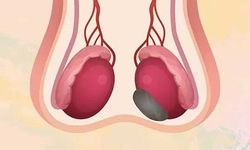 Testislerde Kitle Nedir? Belirtileri, Nedenleri ve Tedavi Yöntemleri