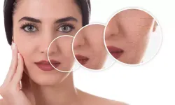 Stres Cildi Nasıl Etkiler Bilimsel Açıklandı