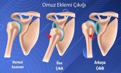 Omuz Çıkığı Nedir? Belirtileri, Tedavisi ve Ameliyat Süreci