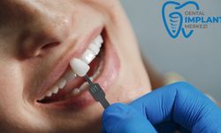 Darıca İmplant Tedavisinde Öne Çıkan Unsurlar ve Klinik Avantajları Nelerdir?