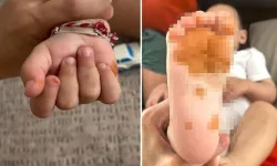 Çocuğunun El Ve Ayaklarındaki Renk Değişimi Gündem Oldu