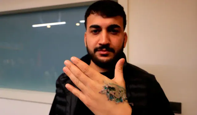 Dövme Sildirme İşlemi Kabusa Döndü, Elinde Yanık Oluştu