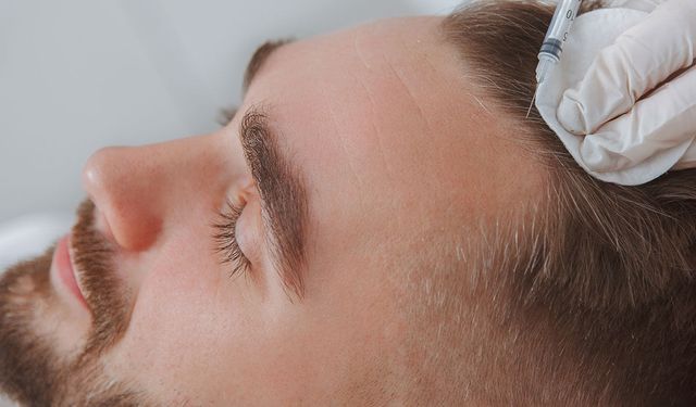 Saç Dökülmesinin Nedenleri ve Kalıcı Çözüm Olarak Saç Ekimi