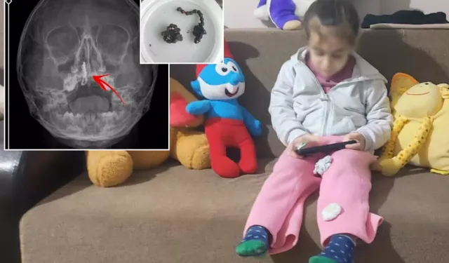 Rize’de Çocuğun Burnundan Metal Parça Çıkarıldı