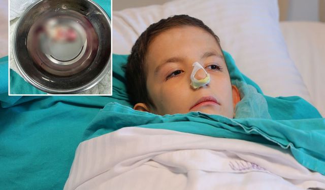 Çocuğun Ağzından Dev Polip Çıkarıldı