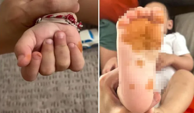 Çocuğunun El Ve Ayaklarındaki Renk Değişimi Gündem Oldu