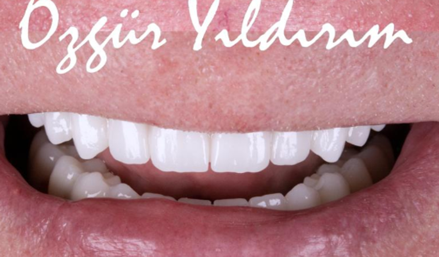 All On 6 Antalya: A Permanent Solution for a Confident Smile