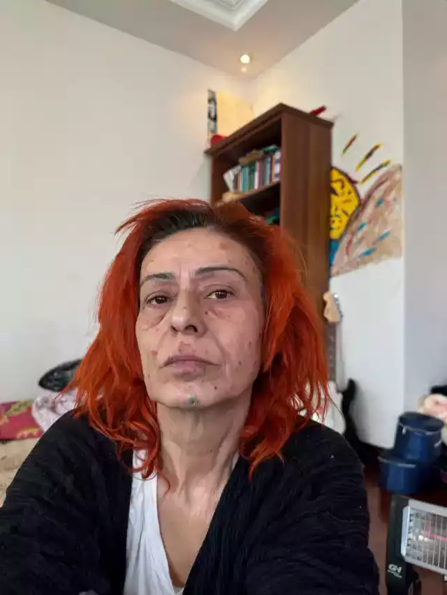 Yildiz Tilbe Nin Yuzu Yandi Son Halini Paylasti 18335577 9786 M