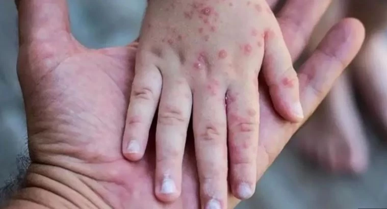 Prof Dr Halil Ozdemirden Maymun Cicegiyle Ilgili Kritik Aciklama Yenicag 1